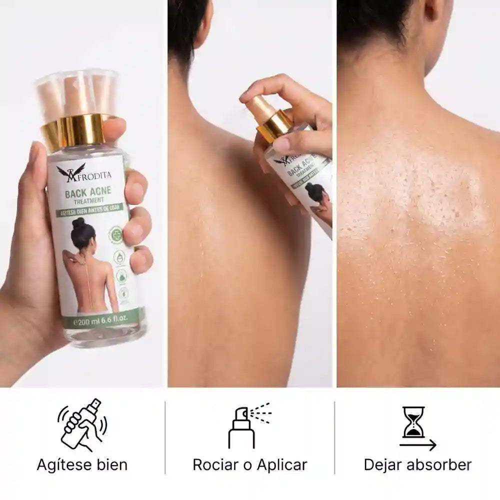 Spray Corporal para Acné y Foliculitis