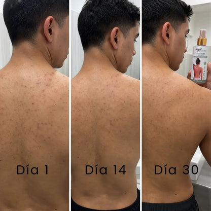 Spray Corporal para Acné y Foliculitis