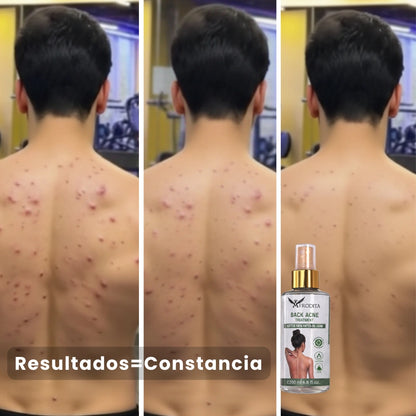 BackControl - Spray Corporal para Acné y Foliculitis