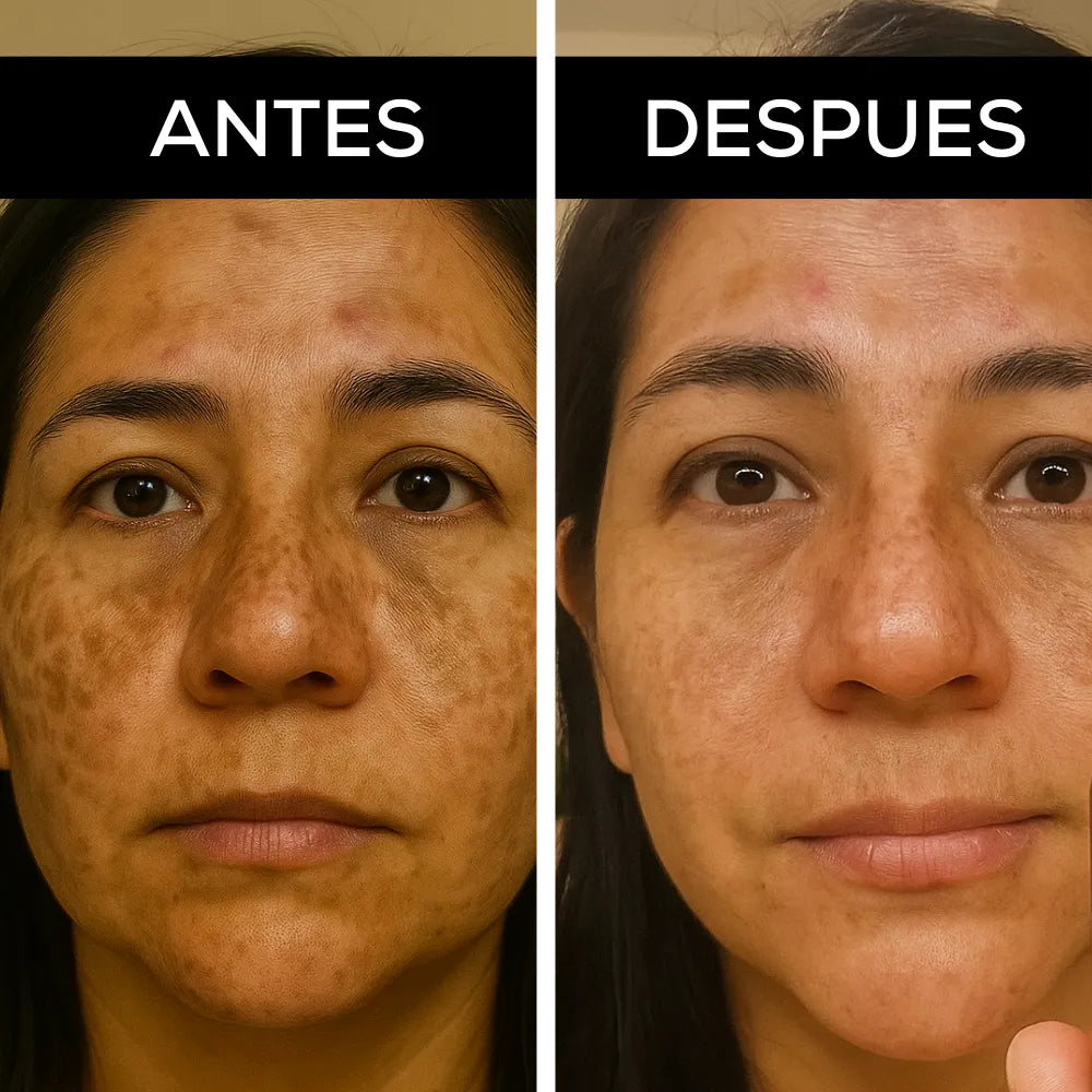 Adiós a las Manchas | Tratamiento despigmentante con ácido kójico y niacinamida