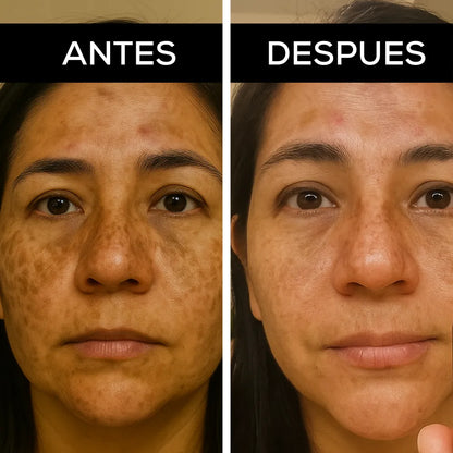 Adiós a las Manchas | Tratamiento despigmentante con ácido kójico y niacinamida